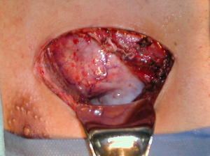 Bronquio del lobulo superior en referencias