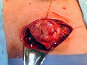 Cierre del mu��n bronquial