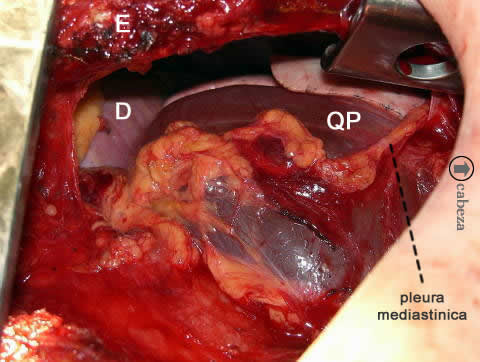 quiste pericardico, mejor expuesto