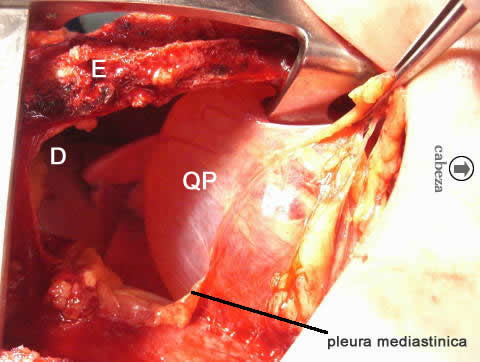 Abierta la pleura mediastinica derecha observen el Quiste