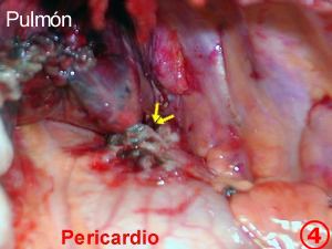 Nodulo pulmonar hallado en la intervencion