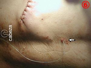 Cateter peridural analgesico