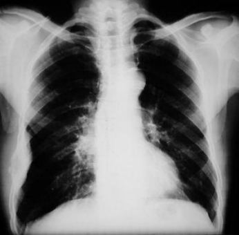 Rx torax: tumor costal