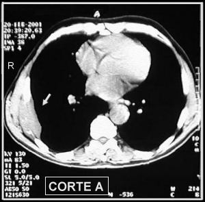Corte Tomogr�fico A