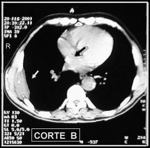 Corte Tomogr�fico B