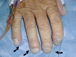 dedos en palillo de tambor