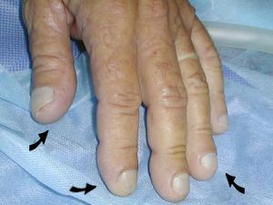 dedos en palillo de tambor