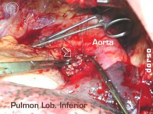 Bronquio del lobulo superior en referencias