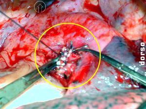 Cierre del mu��n bronquial