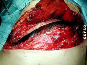 cierre de la pared toracica