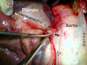 Secci�n del ligamento triangular