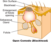 Acne-Blackhead