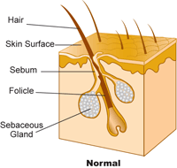 normal Acne- Folicle