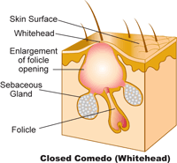Acne-whitehead