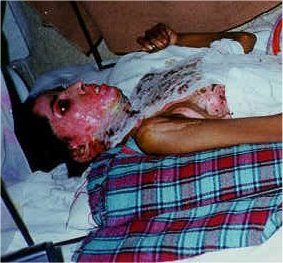 Burn Victims