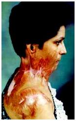 Burn Victims