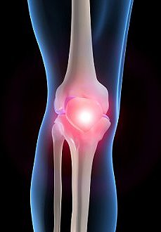 What is knee arthritis? Google image from http://z.about.com/d/orthopedics/1/0/N/4/knee.jpg