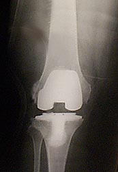 Metal knee replacement part