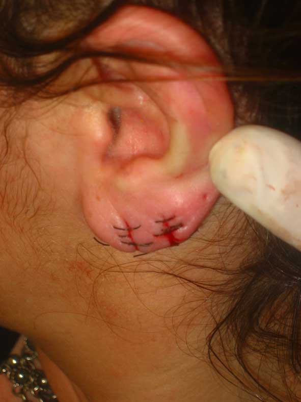 this ladies ear lobes had been ripped for years, Buzz cut then stiched them together - DO NOT TRY THIS AT HOME!!!!