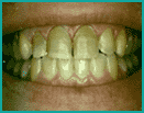 #1 Before