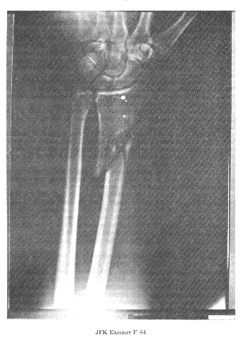 bullet fragments in Connally's wrist, and thigh, Kennedy's head and 60 grams of bullets retrieved in the car,under the seats,etc.