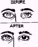 Cornea transplant can restore vision