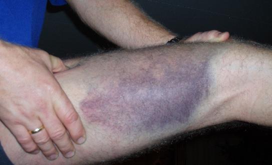 leg_bruise.jpg