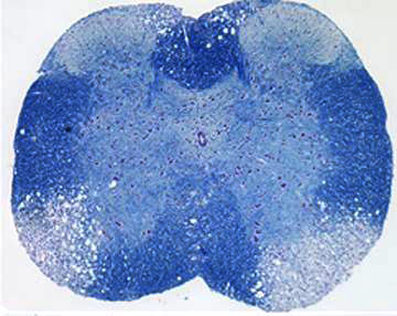 Molecular and cellular pathogenesis of Mouse hepatitis virus (MHV) induced demyelination