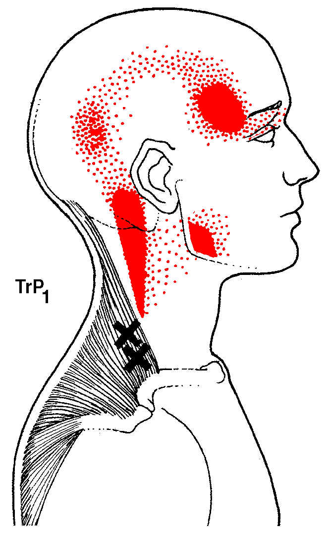 Headache Trigger Points.  Massage in San Antonio, Texas helps.
