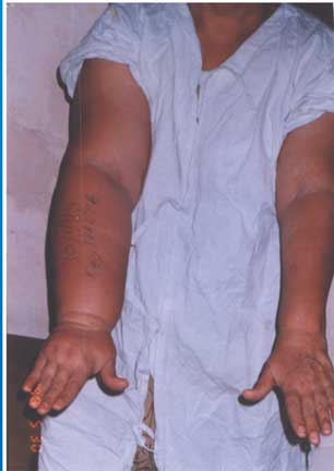 Lymphoedema can effect the arms too - especiallly after cancer surgery