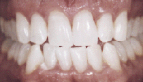 teeth whitening after