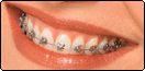 Metal Braces