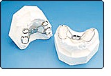 Palatal Expansion Appliance