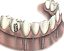 dental implant
