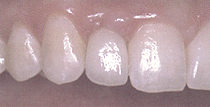 dental implant replacement 