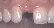 denatl implant single tooth