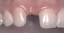 before dental implant