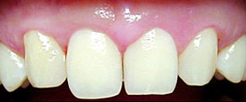 after dental implant