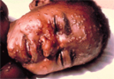 Var�ola humana (smallpox) erradicada com vacina