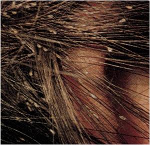 head lice nits glued to hair