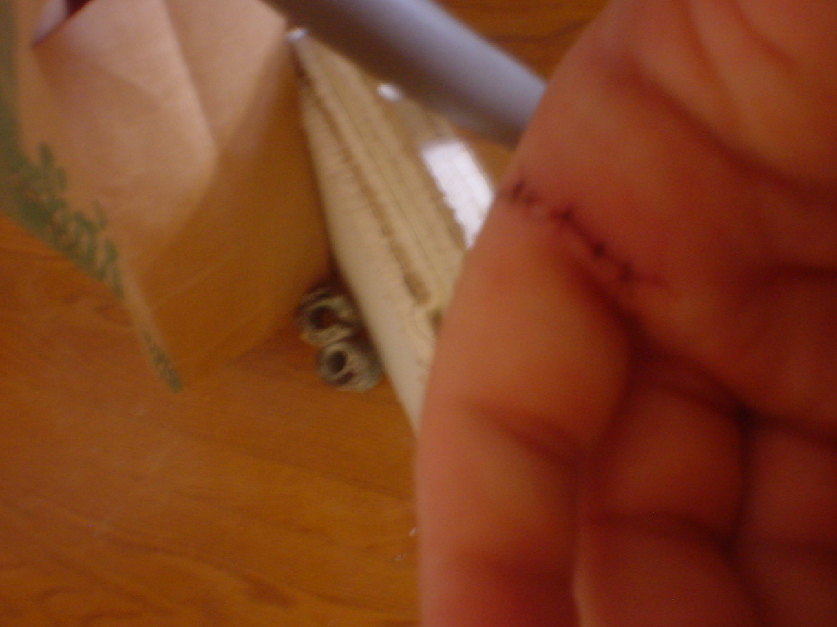 My hand all stitched up.