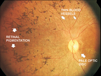retinitis pigmentosa image