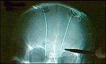 Brain pacemaker probes (JPG)