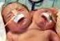 Argentine two-headed (conjoined) baby (JPG)