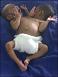 Two-headed (conjoined) babies (JPG)