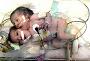 Egyptian two-headed (conjoined) baby (JPG)