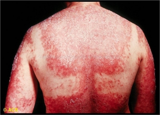 Photosensitive Rash and Resistant Hypertension - scribd.com