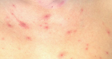 Chicken pox