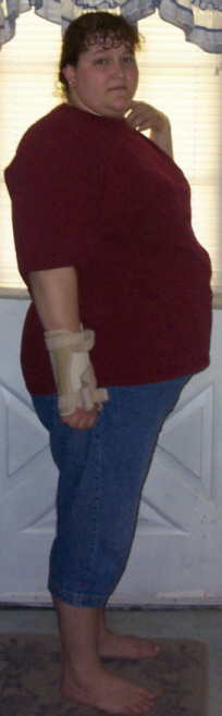 Before & After 146lbs. of&nbsp; Weight Loss