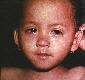 enfant avec rougeole,source: CDC